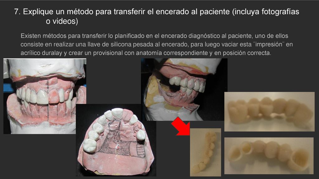 7. Explique un método para transferir el encerado al paciente (incluya fotografías o videos)