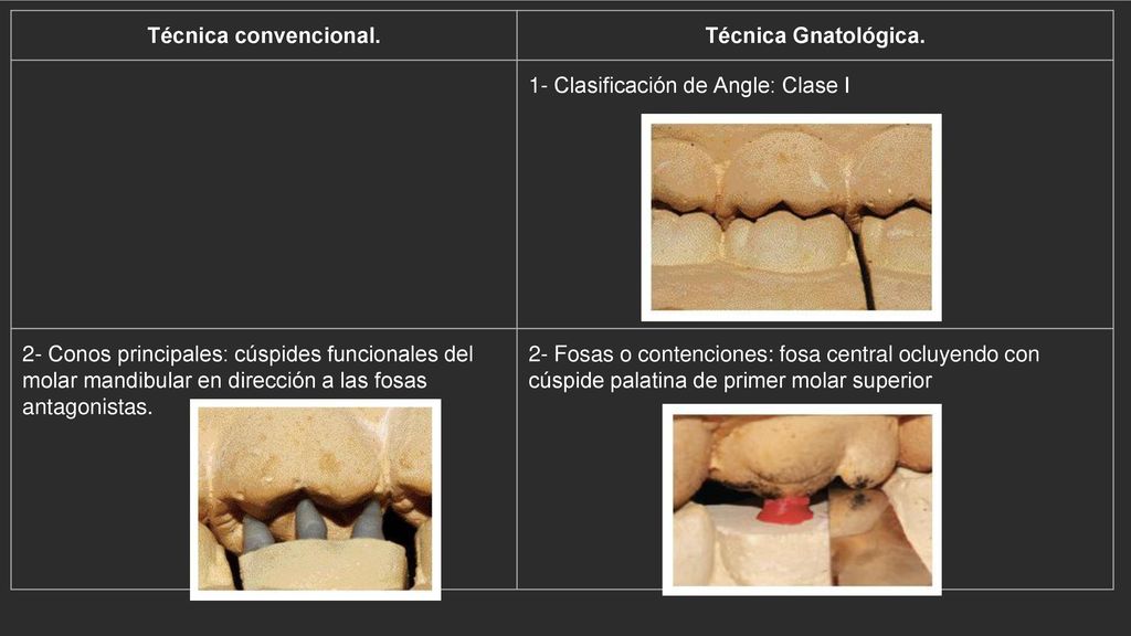 Técnica convencional. Técnica Gnatológica. 1- Clasificación de Angle: Clase I.
