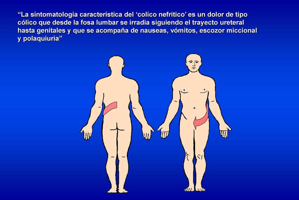 La sintomatología característica del ‘colíco nefritico’ es un dolor de tipo