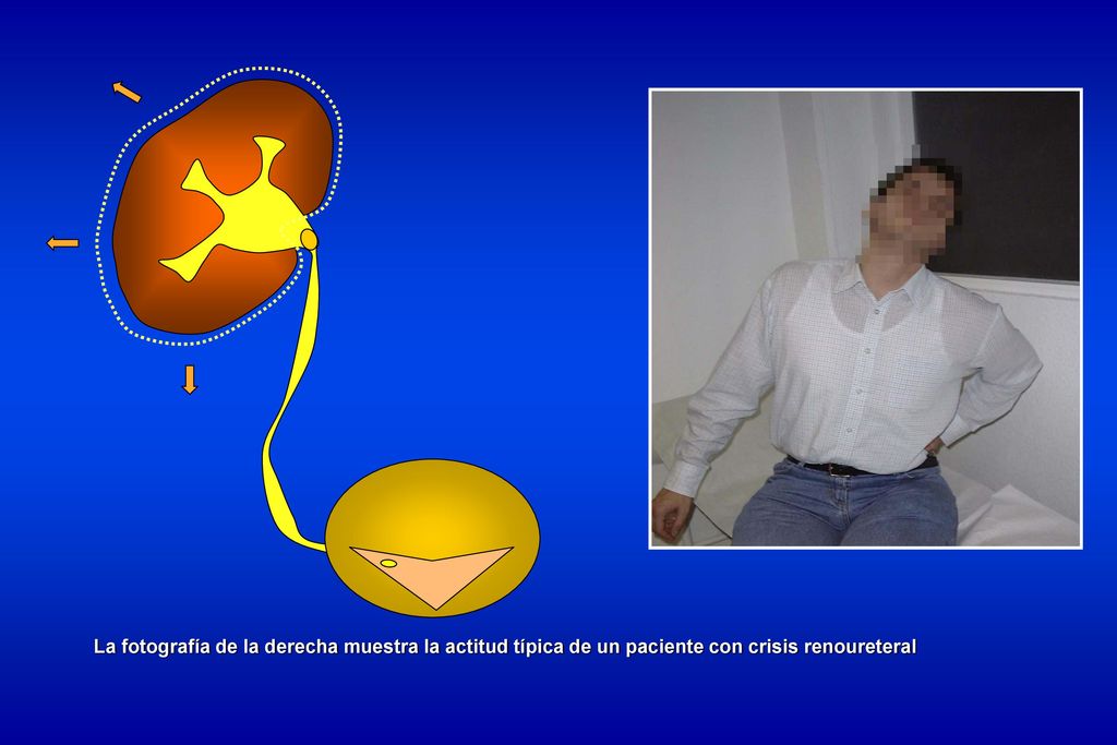 La fotografía de la derecha muestra la actitud típica de un paciente con crisis renoureteral