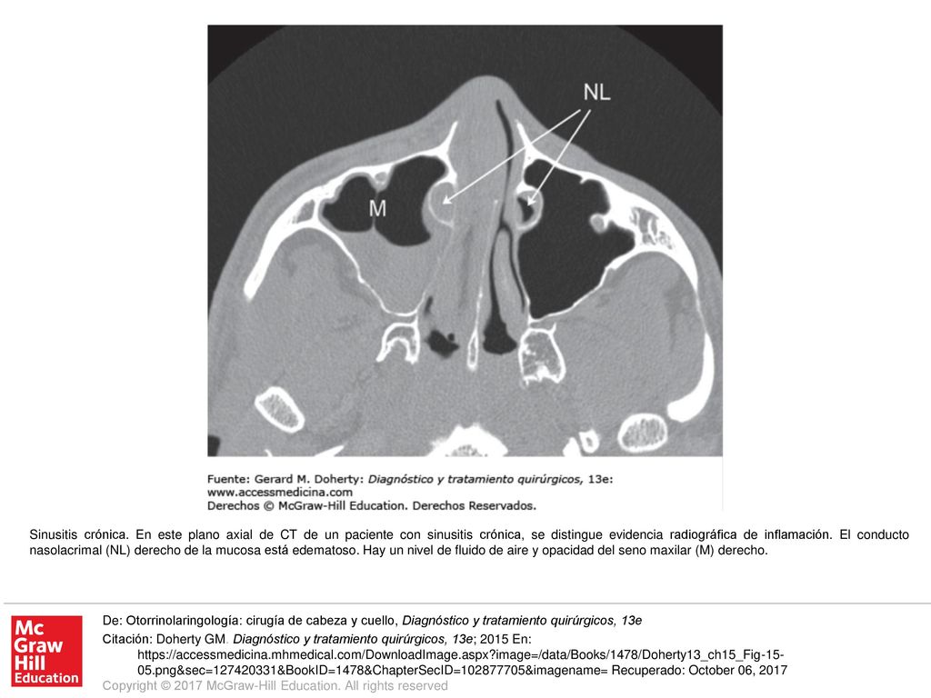 Sinusitis crónica. En este plano axial de CT de un paciente con sinusitis crónica, se distingue evidencia radiográfica de inflamación. El conducto nasolacrimal (NL) derecho de la mucosa está edematoso. Hay un nivel de fluido de aire y opacidad del seno maxilar (M) derecho.