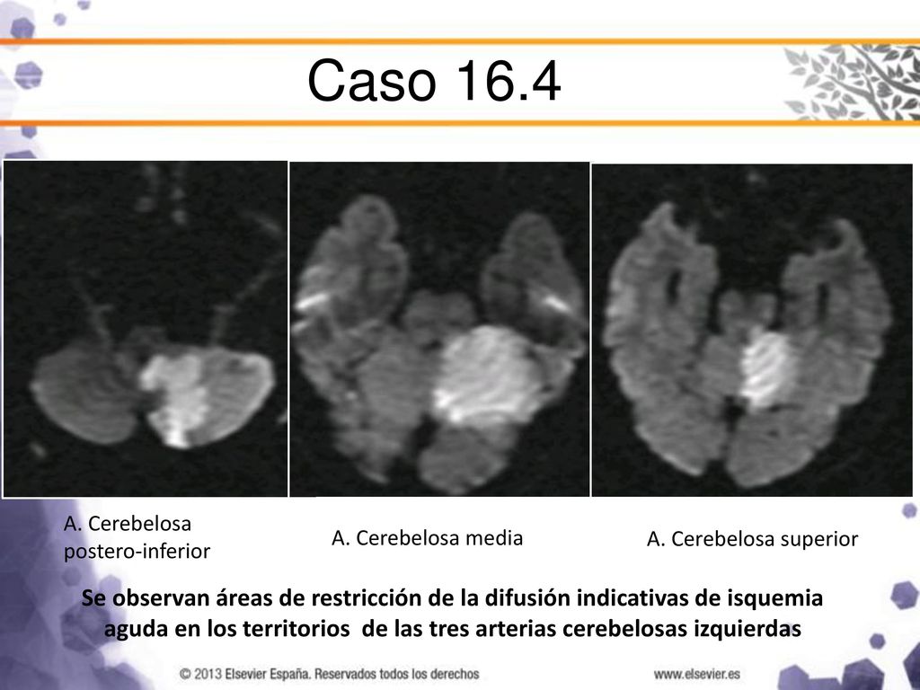 Caso 16.4 A. Cerebelosa postero-inferior. A. Cerebelosa media. A. Cerebelosa superior.