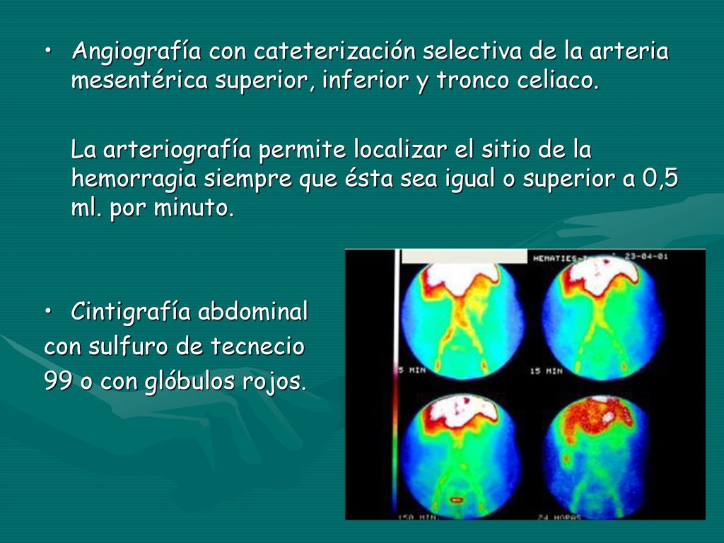 Angiografía con cateterización selectiva de la arteria mesentérica superior, inferior y tronco celiaco.