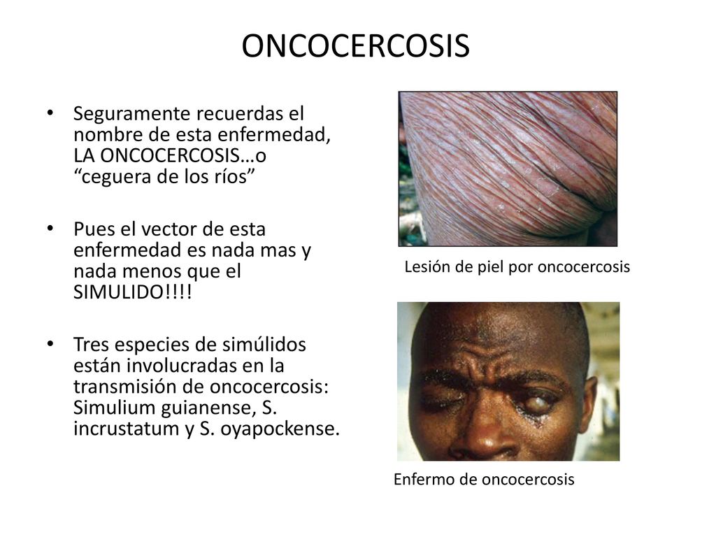ONCOCERCOSIS Seguramente recuerdas el nombre de esta enfermedad, LA ONCOCERCOSIS…o ceguera de los ríos