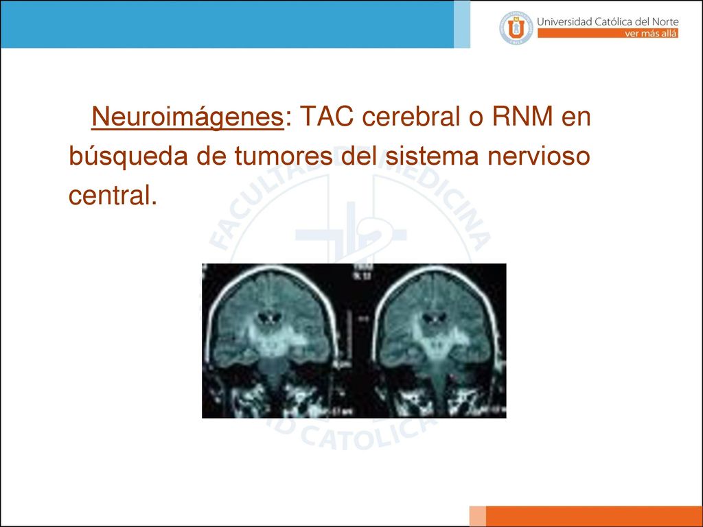 Neuroimágenes: TAC cerebral o RNM en búsqueda de tumores del sistema nervioso central.