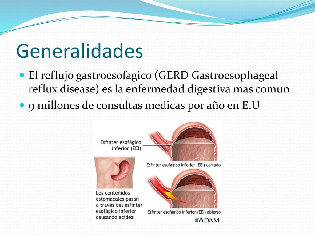 Generalidades El reflujo gastroesofagico (GERD Gastroesophageal reflux disease) es la enfermedad digestiva mas comun.