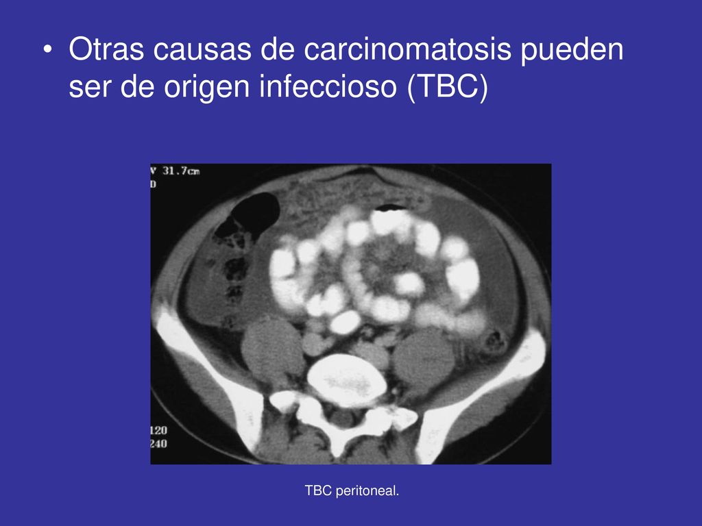 Otras causas de carcinomatosis pueden ser de origen infeccioso (TBC)