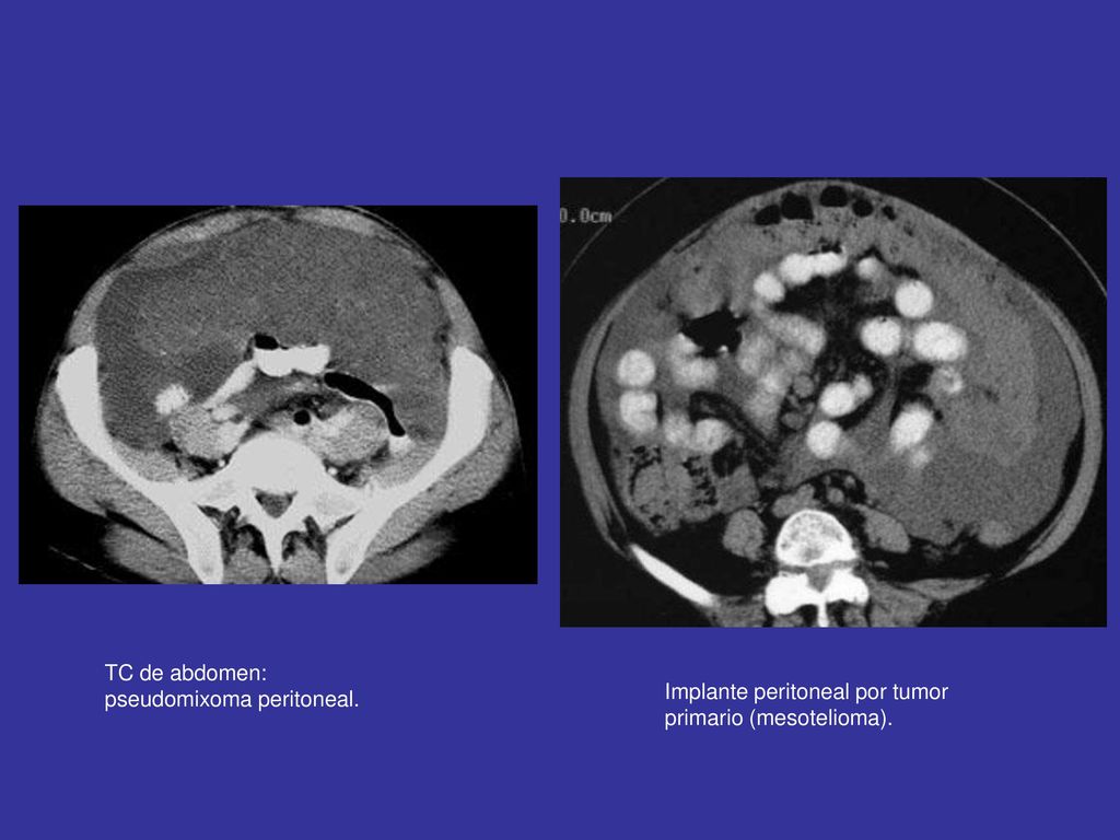TC de abdomen: pseudomixoma peritoneal. Implante peritoneal por tumor primario (mesotelioma).