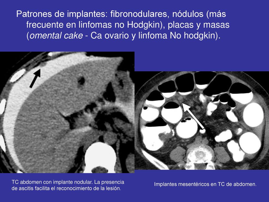 Patrones de implantes: fibronodulares, nódulos (más frecuente en linfomas no Hodgkin), placas y masas (omental cake - Ca ovario y linfoma No hodgkin).