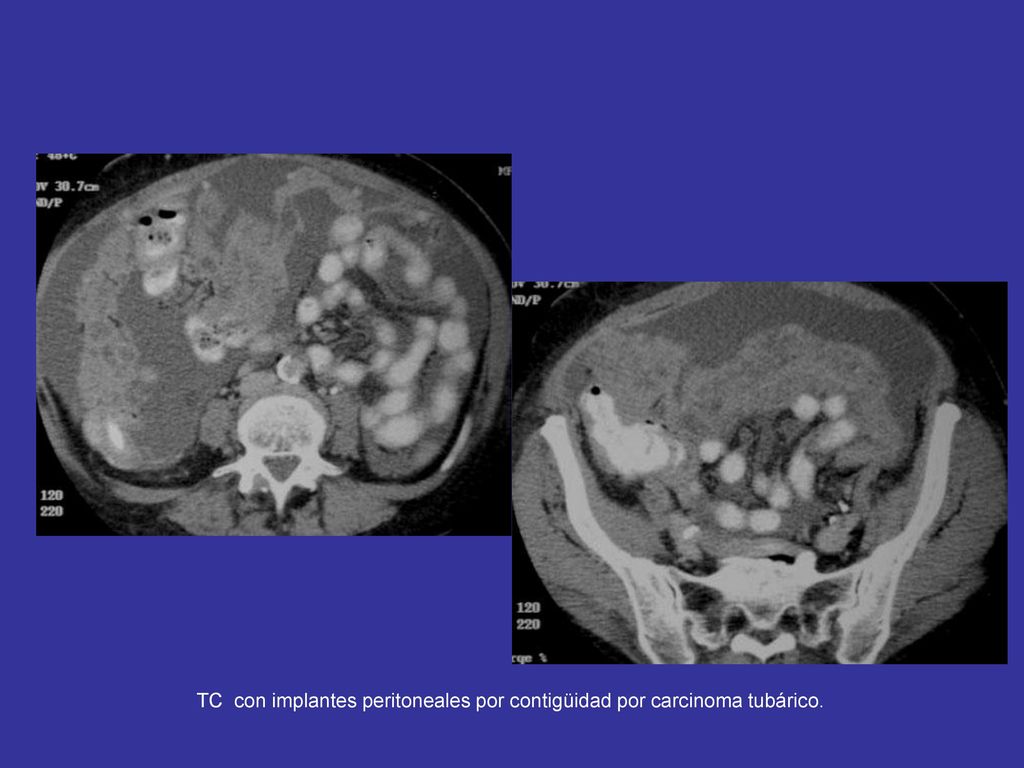 TC con implantes peritoneales por contigüidad por carcinoma tubárico.