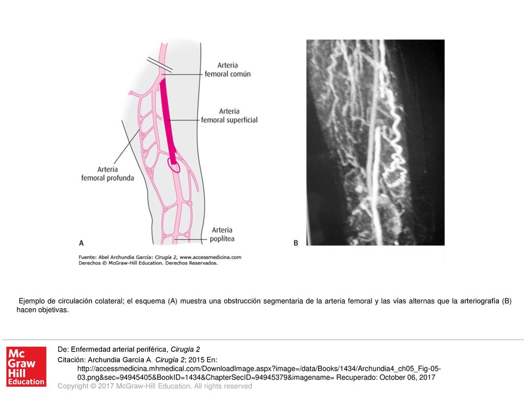 Ejemplo de circulación colateral; el esquema (A) muestra una obstrucción segmentaria de la arteria femoral y las vías alternas que la arteriografía (B) hacen objetivas.
