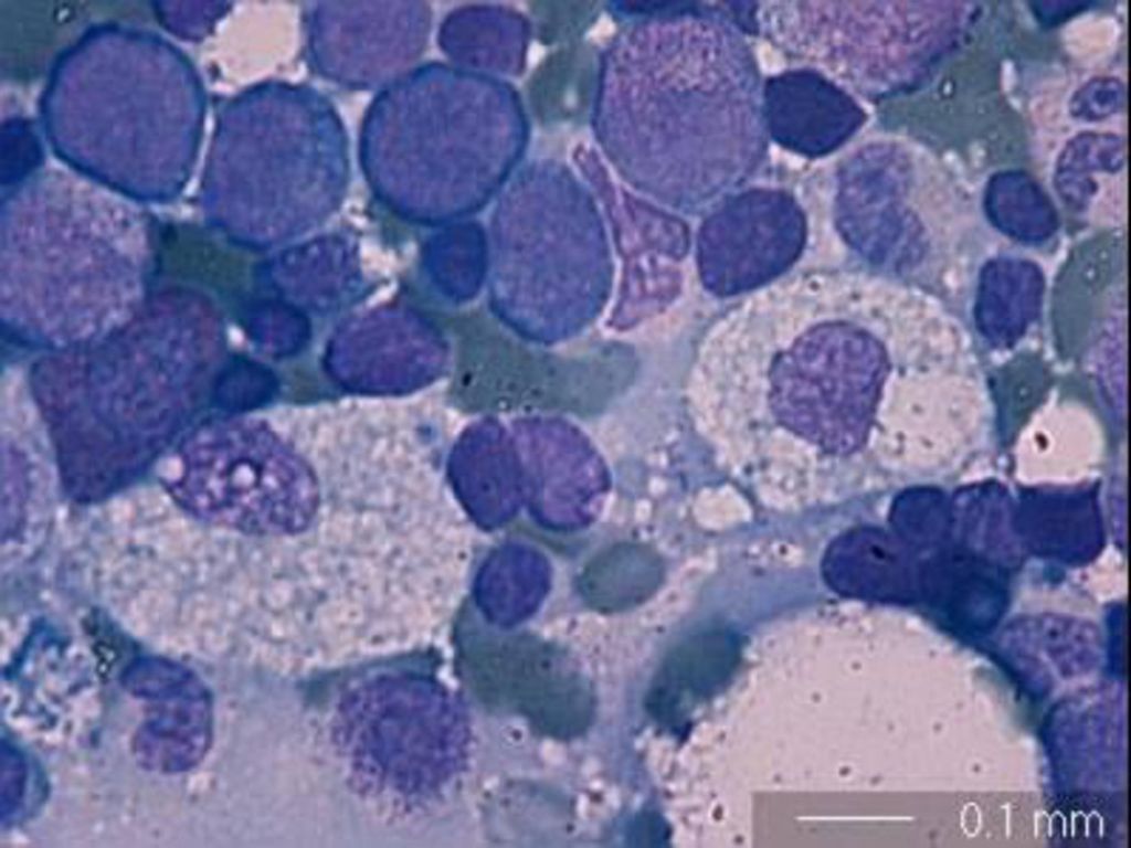 Aspirado médula ósea: Normocelular. Presencia de las tres series hematopoyéticas en proporción y aspecto normal.