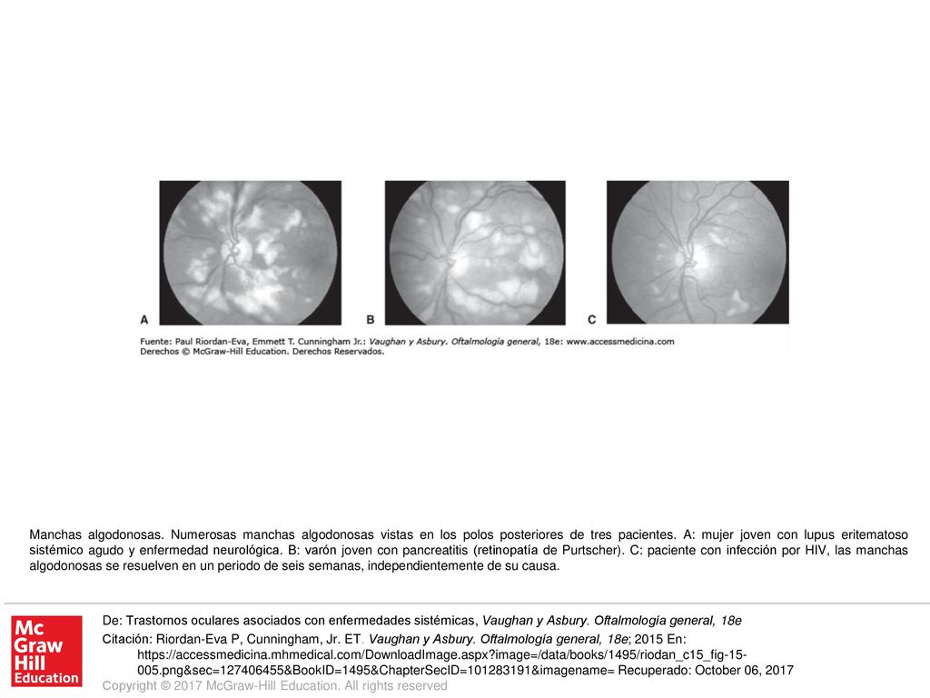 Manchas algodonosas. Numerosas manchas algodonosas vistas en los polos posteriores de tres pacientes. A: mujer joven con lupus eritematoso sistémico agudo y enfermedad neurológica. B: varón joven con pancreatitis (retinopatía de Purtscher). C: paciente con infección por HIV, las manchas algodonosas se resuelven en un periodo de seis semanas, independientemente de su causa.