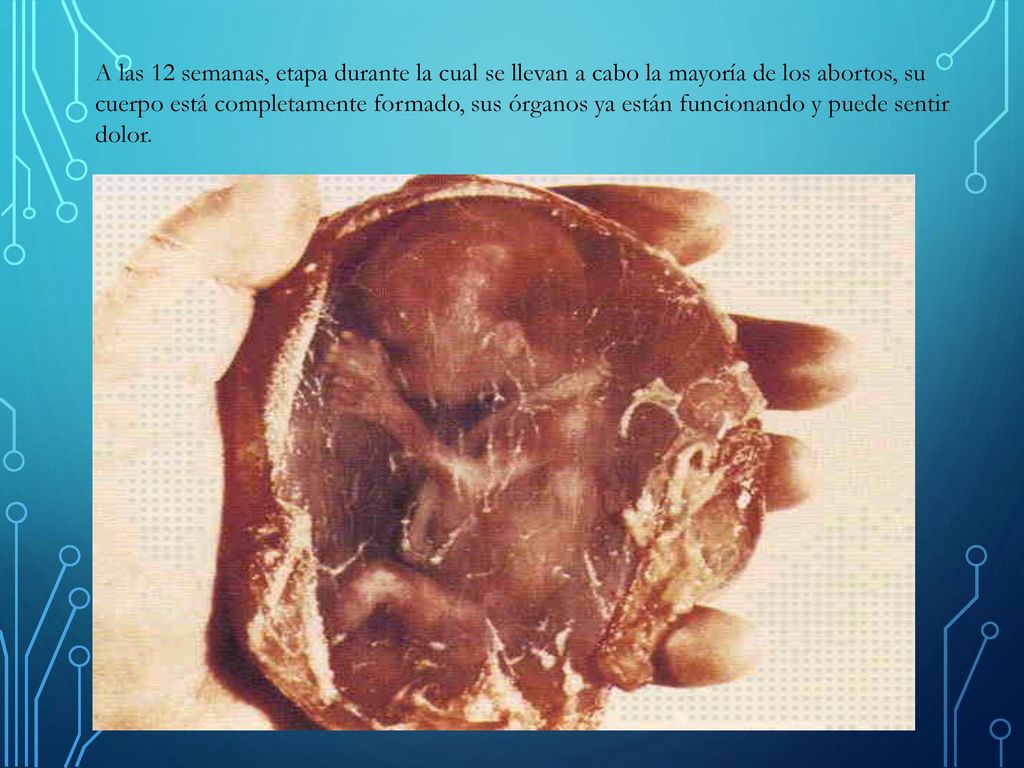 A las 12 semanas, etapa durante la cual se llevan a cabo la mayoría de los abortos, su cuerpo está completamente formado, sus órganos ya están funcionando y puede sentir dolor.