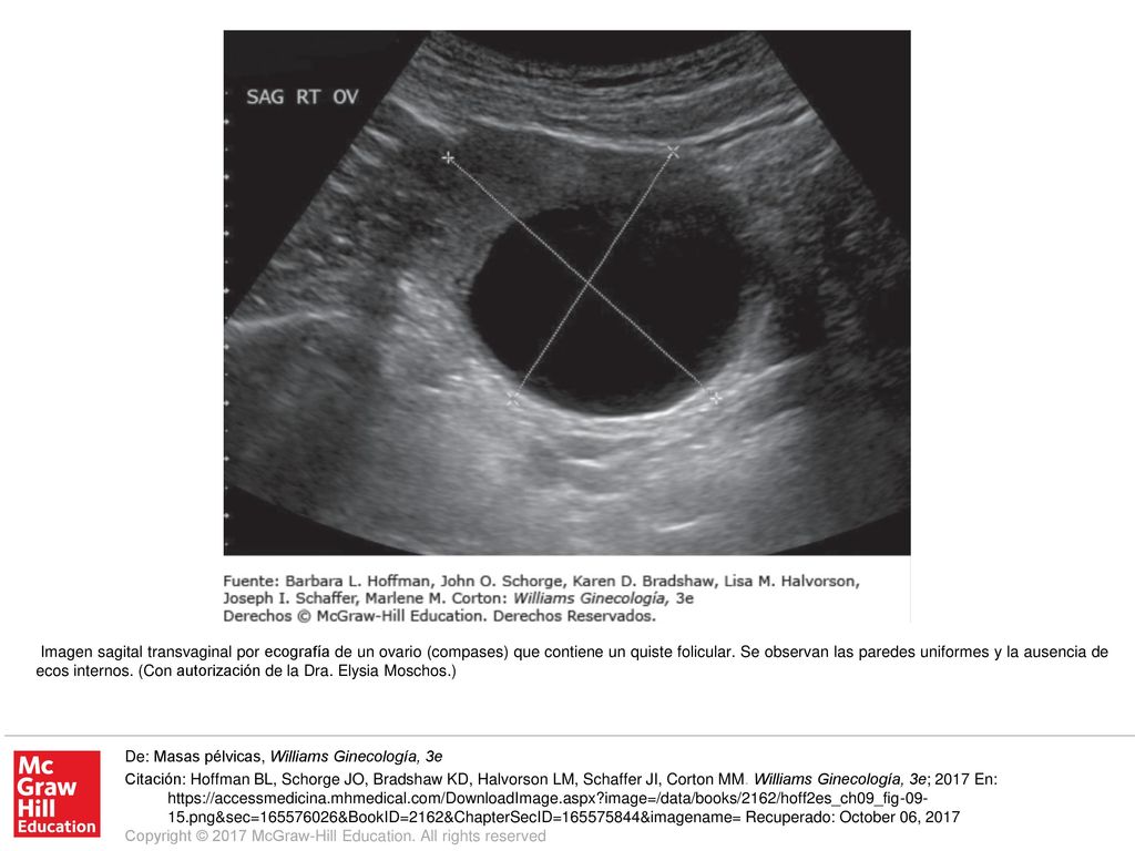 Imagen sagital transvaginal por ecografía de un ovario (compases) que contiene un quiste folicular. Se observan las paredes uniformes y la ausencia de ecos internos. (Con autorización de la Dra. Elysia Moschos.)