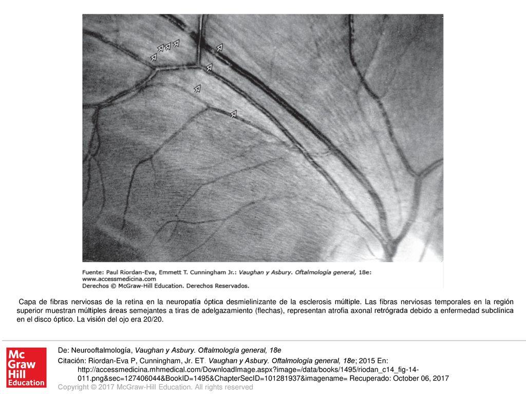 Capa de fibras nerviosas de la retina en la neuropatía óptica desmielinizante de la esclerosis múltiple. Las fibras nerviosas temporales en la región superior muestran múltiples áreas semejantes a tiras de adelgazamiento (flechas), representan atrofia axonal retrógrada debido a enfermedad subclínica en el disco óptico. La visión del ojo era 20/20.
