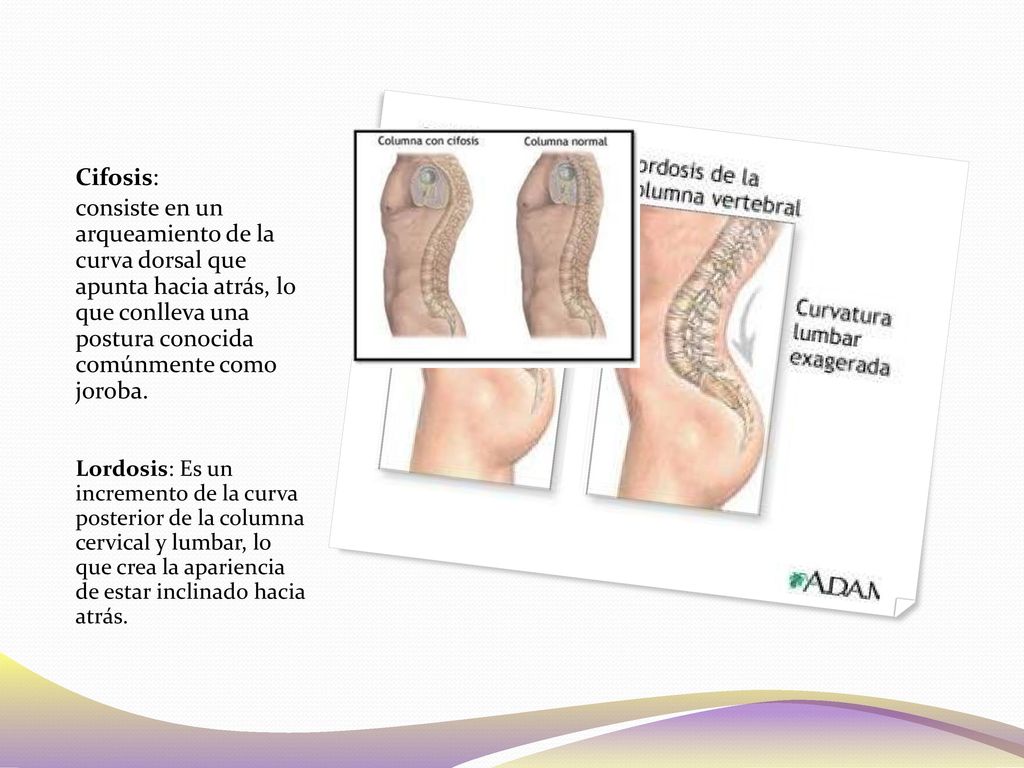 Cifosis: consiste en un arqueamiento de la curva dorsal que apunta hacia atrás, lo que conlleva una postura conocida comúnmente como joroba.