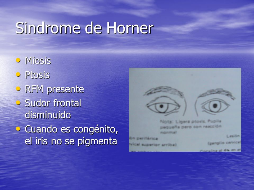 Sindrome de Horner Miosis Ptosis RFM presente Sudor frontal disminuido