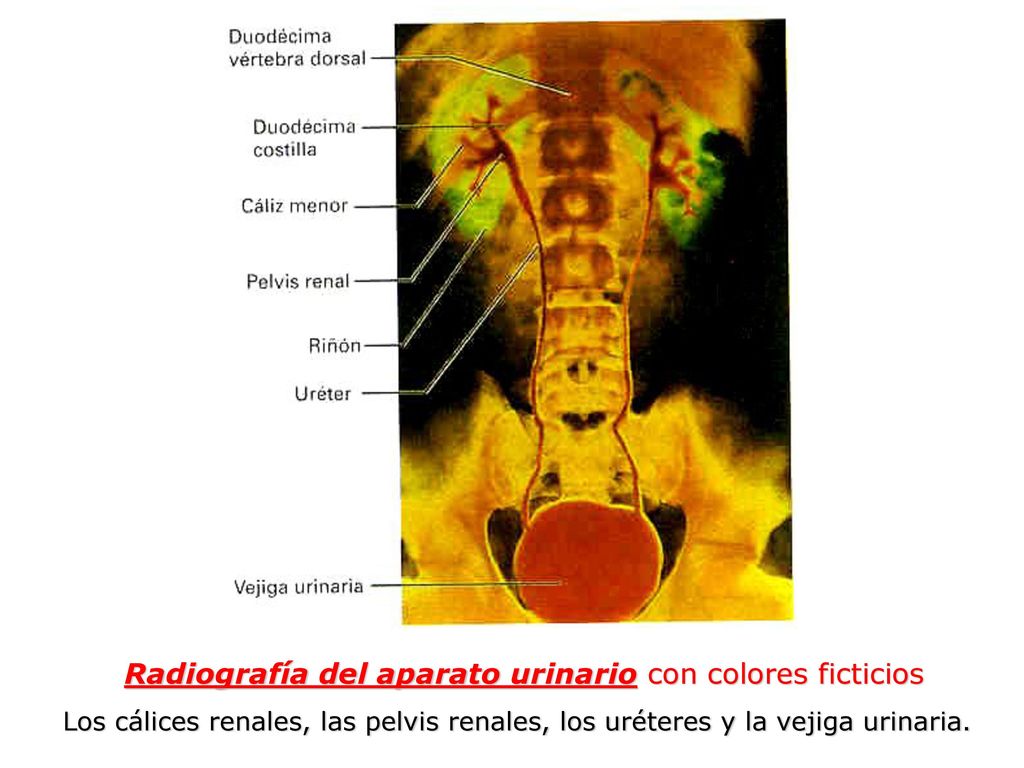 Radiografía del aparato urinario con colores ficticios