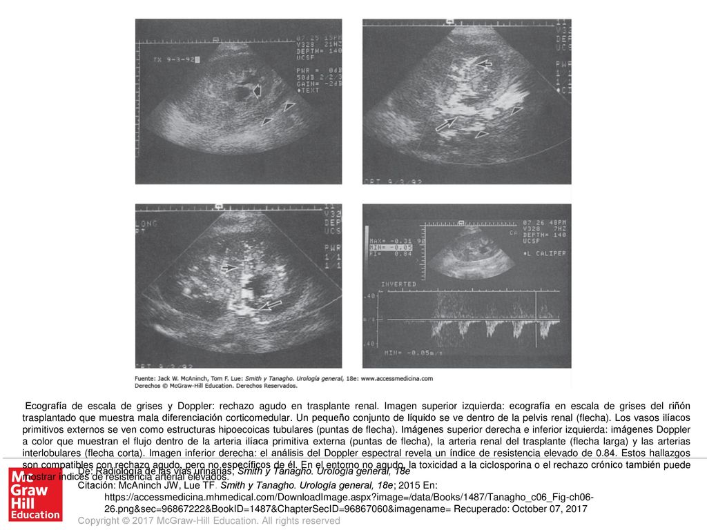 Ecografía de escala de grises y Doppler: rechazo agudo en trasplante renal. Imagen superior izquierda: ecografía en escala de grises del riñón trasplantado que muestra mala diferenciación corticomedular. Un pequeño conjunto de líquido se ve dentro de la pelvis renal (flecha). Los vasos ilíacos primitivos externos se ven como estructuras hipoecoicas tubulares (puntas de flecha). Imágenes superior derecha e inferior izquierda: imágenes Doppler a color que muestran el flujo dentro de la arteria ilíaca primitiva externa (puntas de flecha), la arteria renal del trasplante (flecha larga) y las arterias interlobulares (flecha corta). Imagen inferior derecha: el análisis del Doppler espectral revela un índice de resistencia elevado de Estos hallazgos son compatibles con rechazo agudo, pero no específicos de él. En el entorno no agudo, la toxicidad a la ciclosporina o el rechazo crónico también puede mostrar índices de resistencia arterial elevados.