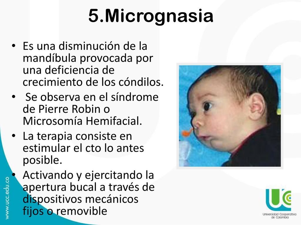 5.Micrognasia Es una disminución de la mandíbula provocada por una deficiencia de crecimiento de los cóndilos.