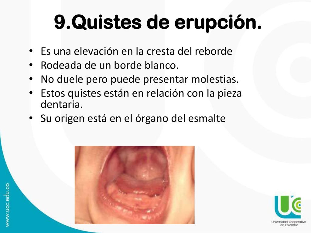 9.Quistes de erupción. Es una elevación en la cresta del reborde