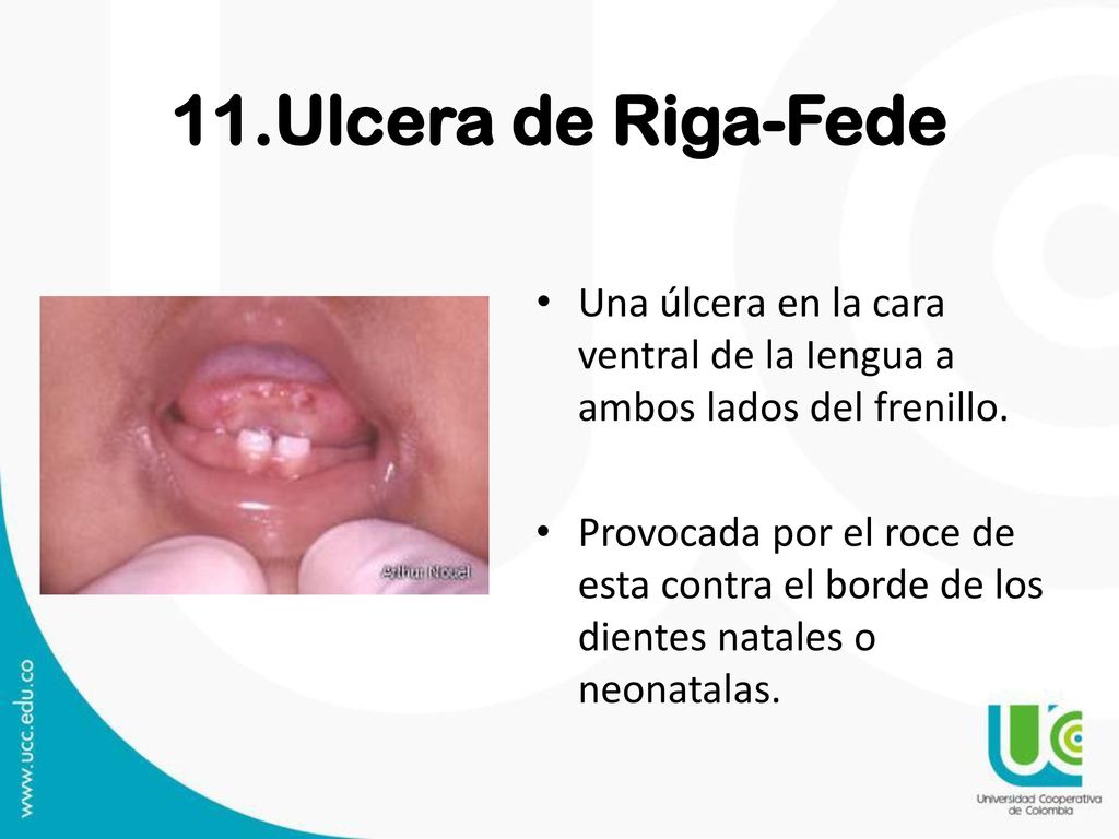 11.Ulcera de Riga-Fede Una úlcera en la cara ventral de la Iengua a ambos lados del frenillo.