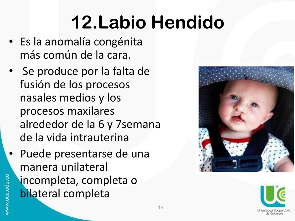 12.Labio Hendido Es la anomalía congénita más común de la cara.