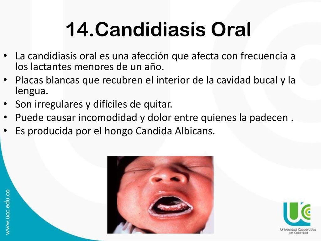 14.Candidiasis Oral La candidiasis oral es una afección que afecta con frecuencia a los lactantes menores de un año.