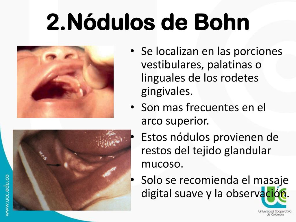 2.Nódulos de Bohn Se localizan en las porciones vestibulares, palatinas o linguales de los rodetes gingivales.