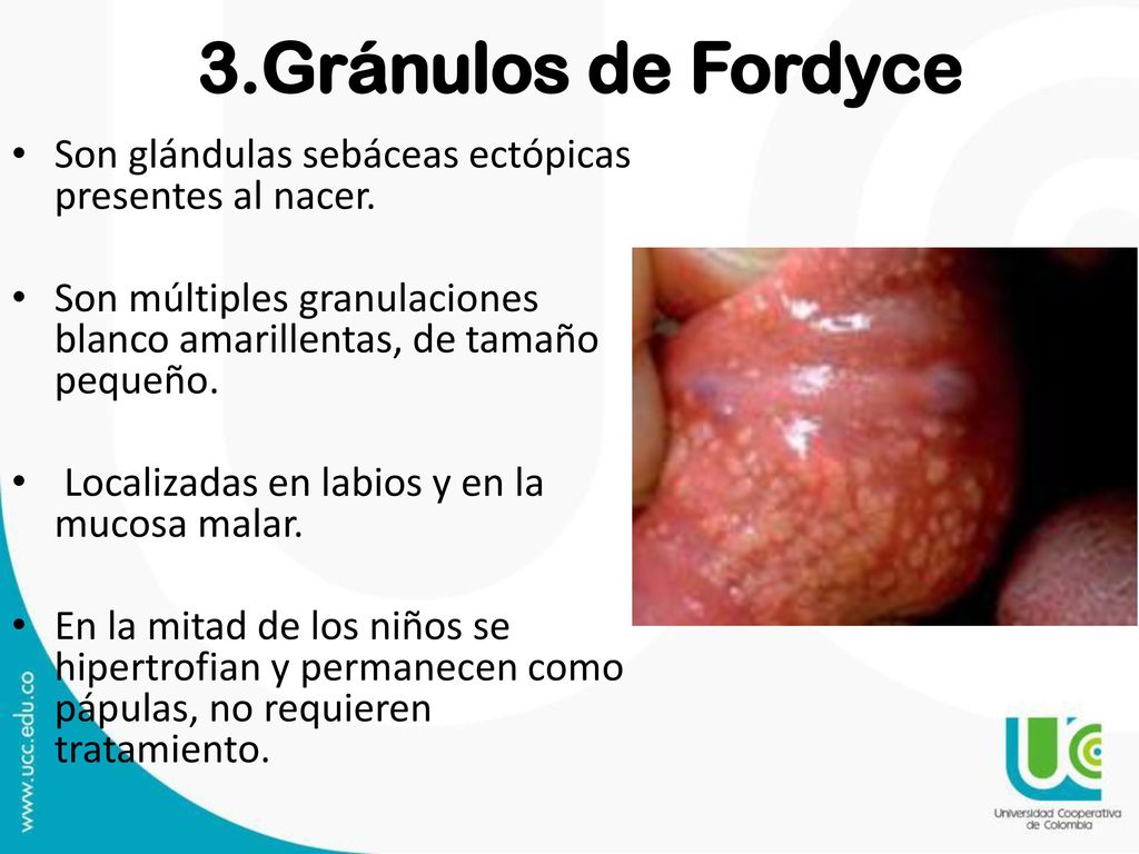 3.Gránulos de Fordyce Son glándulas sebáceas ectópicas presentes al nacer. Son múltiples granulaciones blanco amarillentas, de tamaño pequeño.