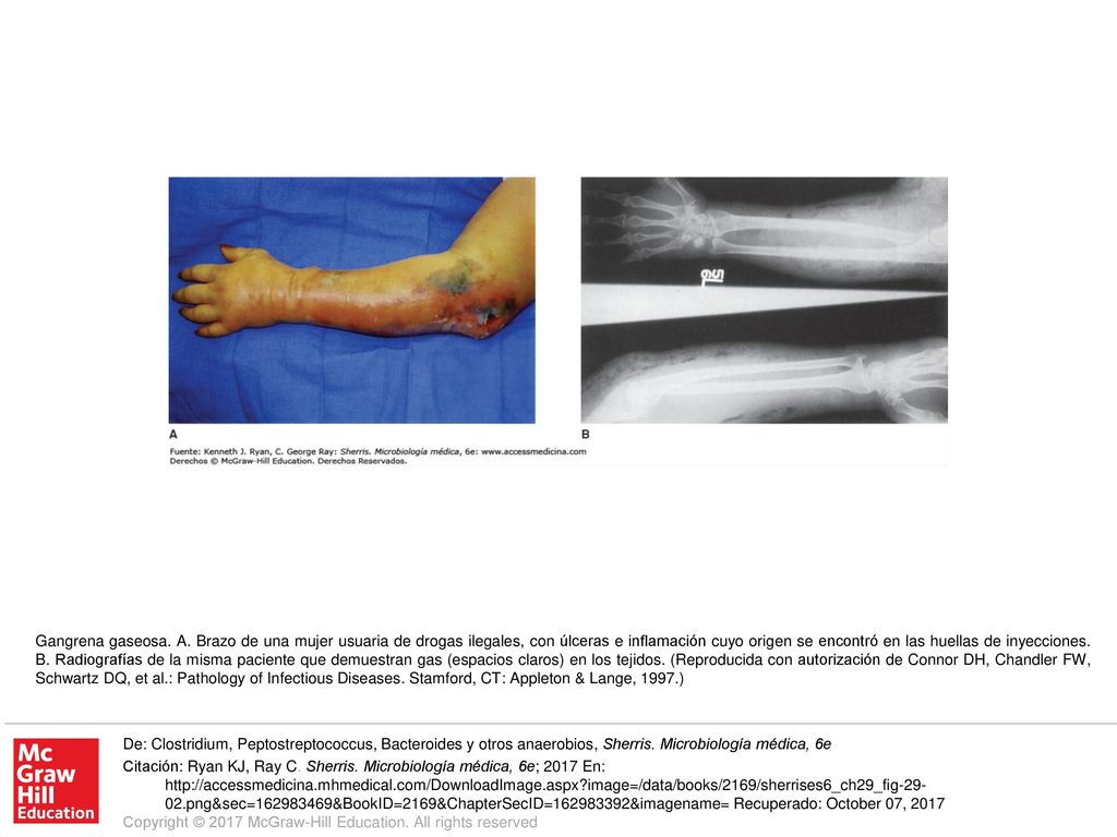 Gangrena gaseosa. A. Brazo de una mujer usuaria de drogas ilegales, con úlceras e inflamación cuyo origen se encontró en las huellas de inyecciones. B. Radiografías de la misma paciente que demuestran gas (espacios claros) en los tejidos. (Reproducida con autorización de Connor DH, Chandler FW, Schwartz DQ, et al.: Pathology of Infectious Diseases. Stamford, CT: Appleton & Lange, 1997.)