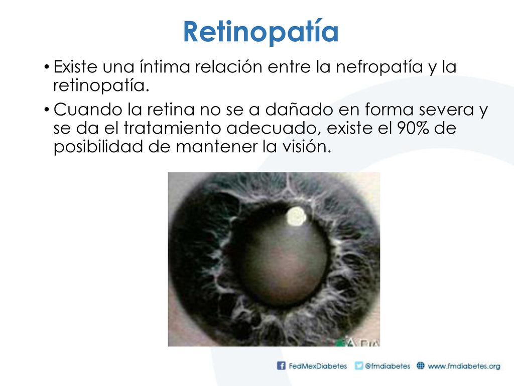 Retinopatía Existe una íntima relación entre la nefropatía y la retinopatía.