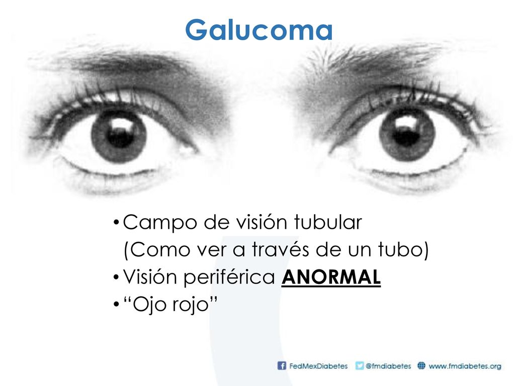 Galucoma Campo de visión tubular (Como ver a través de un tubo)