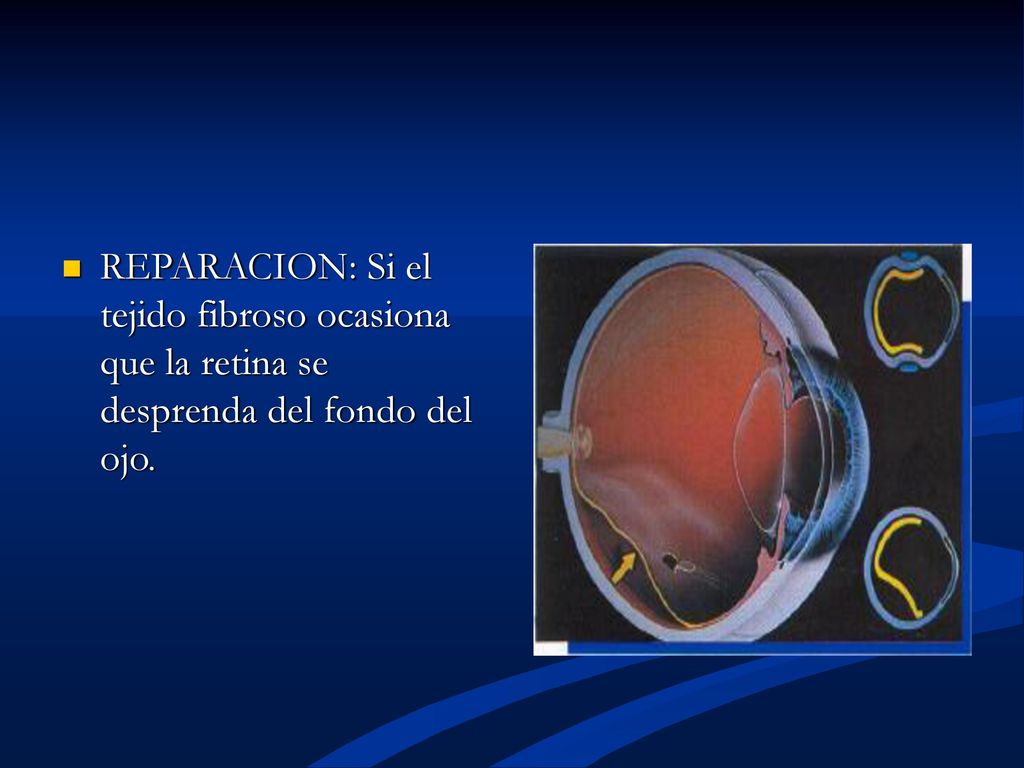 REPARACION: Si el tejido fibroso ocasiona que la retina se desprenda del fondo del ojo.