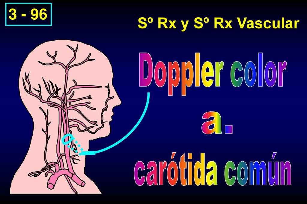 Doppler color a. carótida común