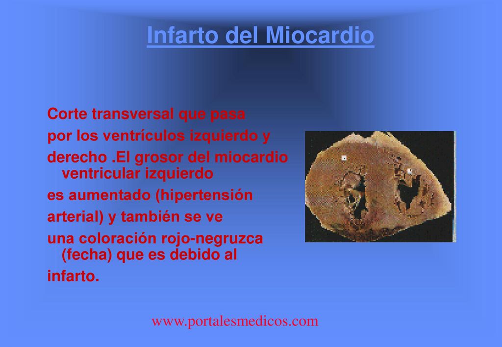 Infarto del Miocardio Corte transversal que pasa
