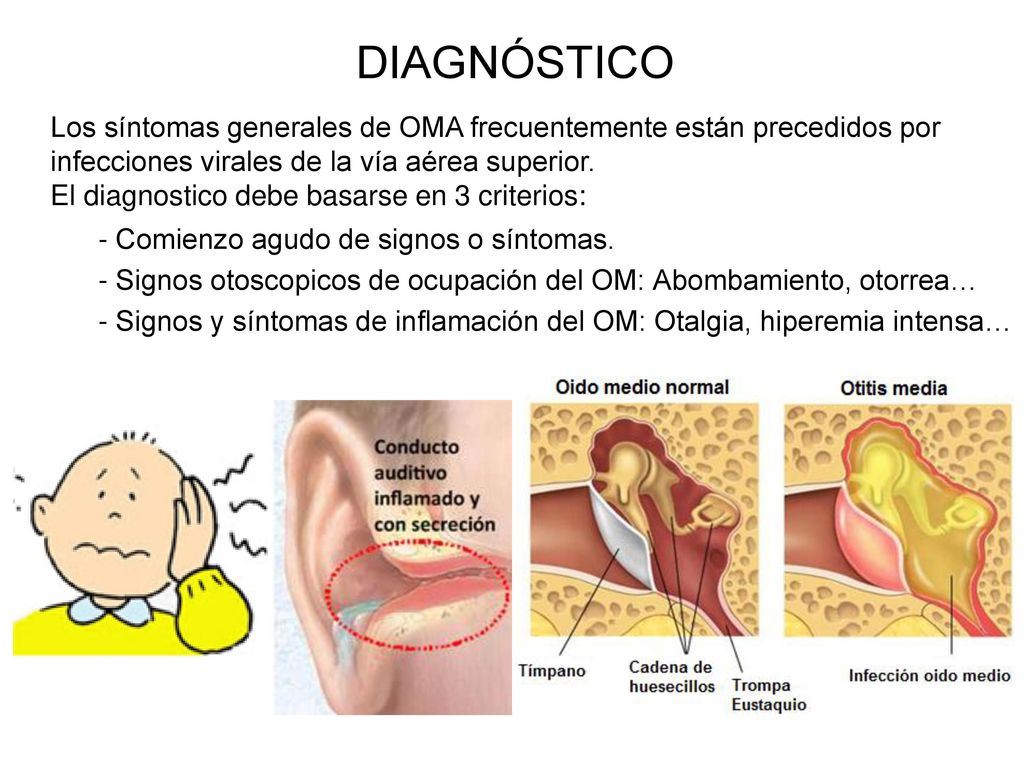 DIAGNÓSTICO Los síntomas generales de OMA frecuentemente están precedidos por infecciones virales de la vía aérea superior.