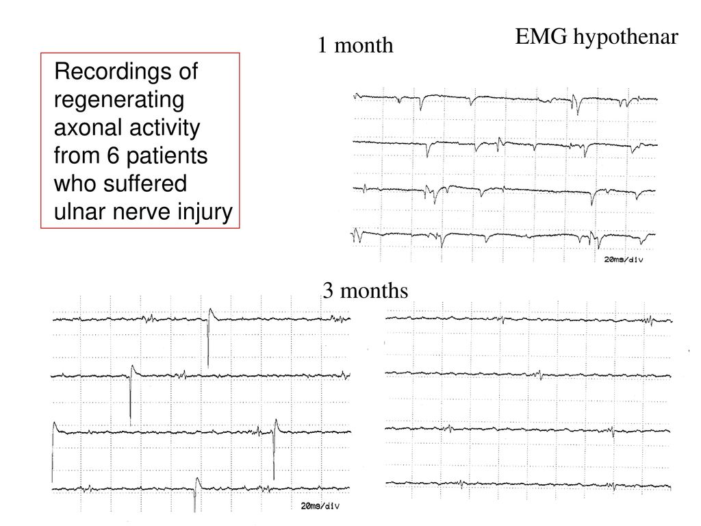 EMG hypothenar 1 month. Recordings of. regenerating. axonal activity. from 6 patients. who suffered.