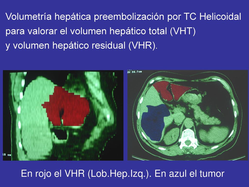 En rojo el VHR (Lob.Hep.Izq.). En azul el tumor
