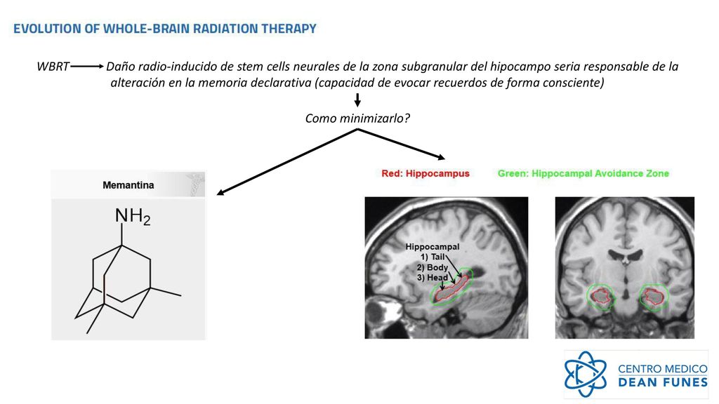 WBRT Daño radio-inducido de stem cells neurales de la zona subgranular del hipocampo seria responsable de la alteración en la memoria declarativa (capacidad de evocar recuerdos de forma consciente)