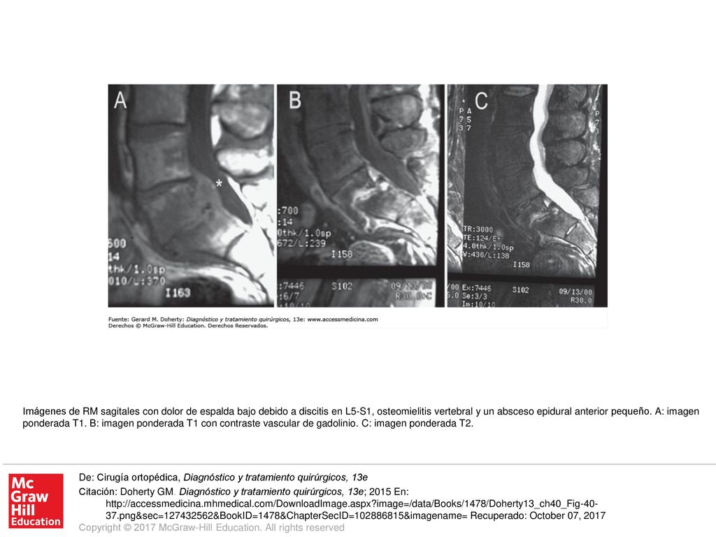 Imágenes de RM sagitales con dolor de espalda bajo debido a discitis en L5-S1, osteomielitis vertebral y un absceso epidural anterior pequeño. A: imagen ponderada T1. B: imagen ponderada T1 con contraste vascular de gadolinio. C: imagen ponderada T2.