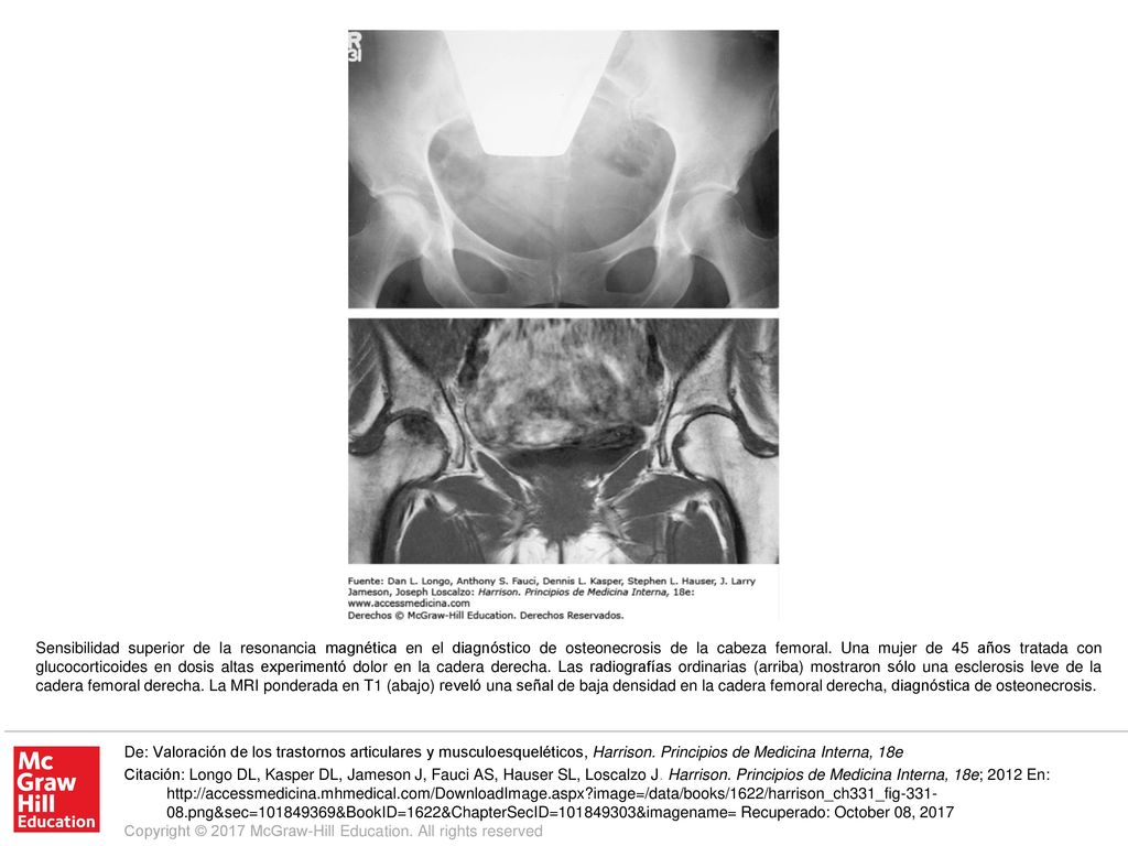 Sensibilidad superior de la resonancia magnética en el diagnóstico de osteonecrosis de la cabeza femoral. Una mujer de 45 años tratada con glucocorticoides en dosis altas experimentó dolor en la cadera derecha. Las radiografías ordinarias (arriba) mostraron sólo una esclerosis leve de la cadera femoral derecha. La MRI ponderada en T1 (abajo) reveló una señal de baja densidad en la cadera femoral derecha, diagnóstica de osteonecrosis.