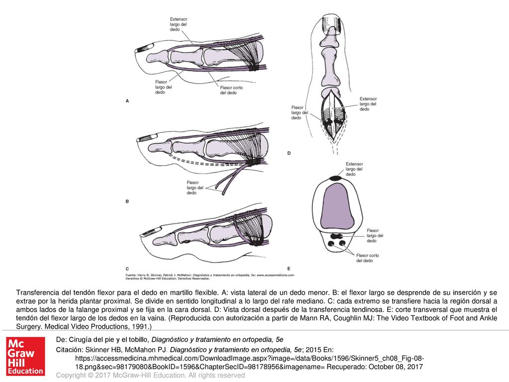 Transferencia del tendón flexor para el dedo en martillo flexible