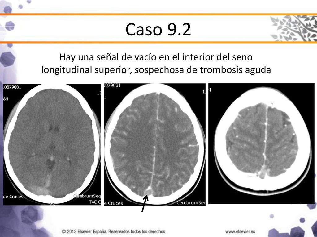 Caso 9.2 Hay una señal de vacío en el interior del seno longitudinal superior, sospechosa de trombosis aguda.