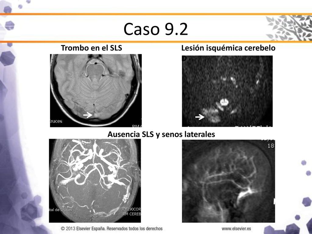Caso 9.2 Trombo en el SLS Lesión isquémica cerebelo D