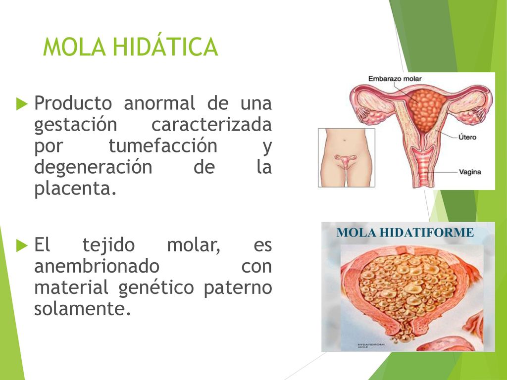 MOLA HIDÁTICA Producto anormal de una gestación caracterizada por tumefacción y degeneración de la placenta.