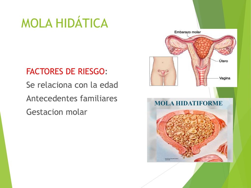 MOLA HIDÁTICA FACTORES DE RIESGO: Se relaciona con la edad Antecedentes familiares Gestacion molar