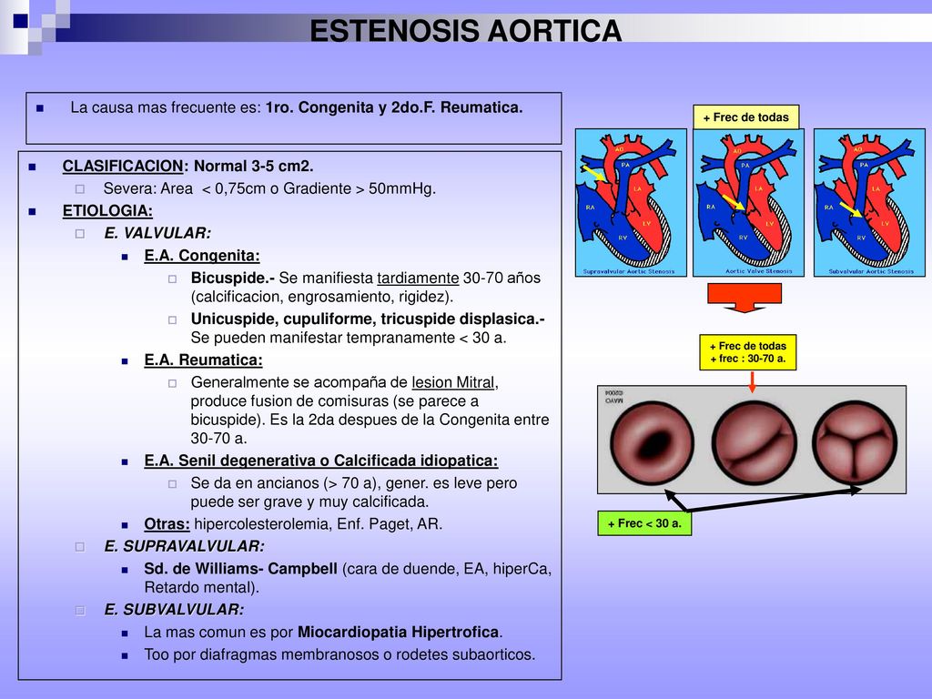ESTENOSIS AORTICA La causa mas frecuente es: 1ro. Congenita y 2do.F. Reumatica. + Frec de todas. CLASIFICACION: Normal 3-5 cm2.