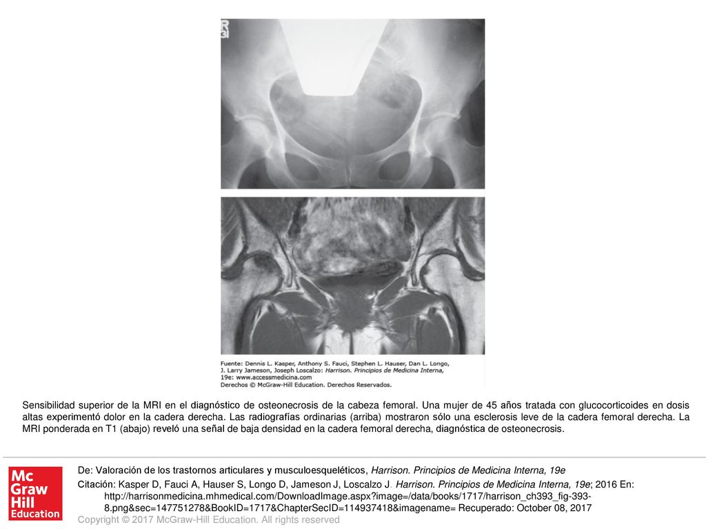 Sensibilidad superior de la MRI en el diagnóstico de osteonecrosis de la cabeza femoral. Una mujer de 45 años tratada con glucocorticoides en dosis altas experimentó dolor en la cadera derecha. Las radiografías ordinarias (arriba) mostraron sólo una esclerosis leve de la cadera femoral derecha. La MRI ponderada en T1 (abajo) reveló una señal de baja densidad en la cadera femoral derecha, diagnóstica de osteonecrosis.